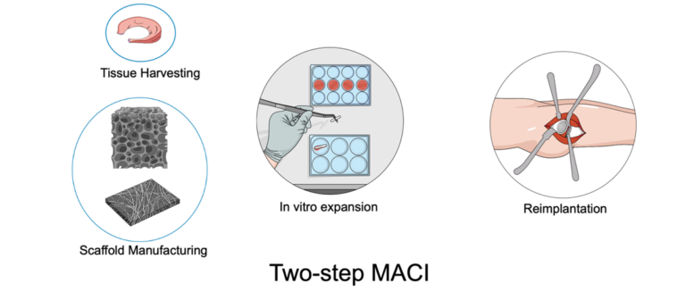 What is matrix-assisted chondrocyte implantation (MACI)? - BioTrib